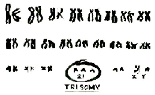 A karyotype with three copies of chromosome 21 (Trisomy 21)